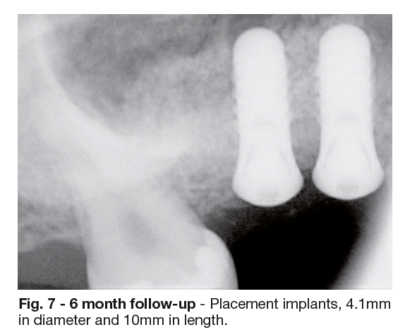 Clinical Case Study: Sinus filling for Implant Placement